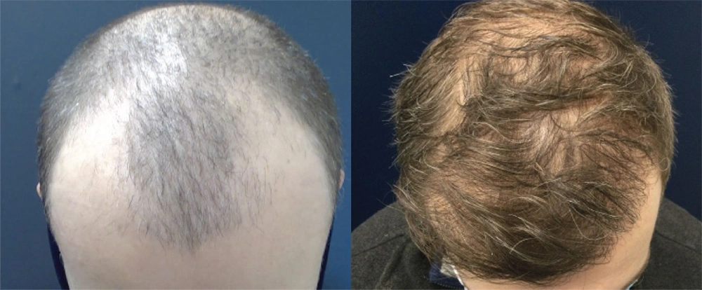 44before.1.jpg