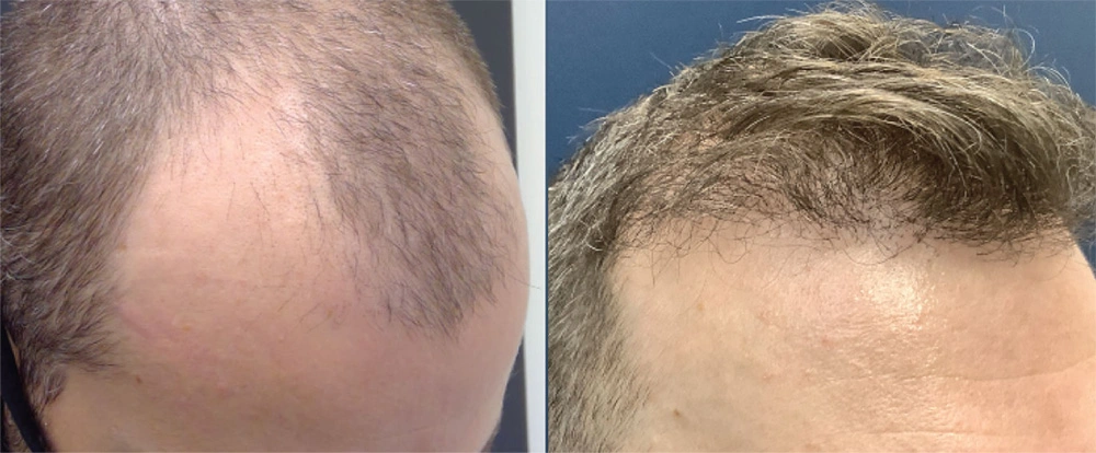 44before.jpg
