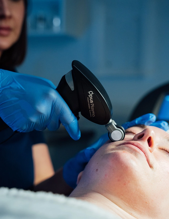 Medical professional performing laser hair removal treatment on patient's face with handheld device - Opus plasma in Wayne, PA