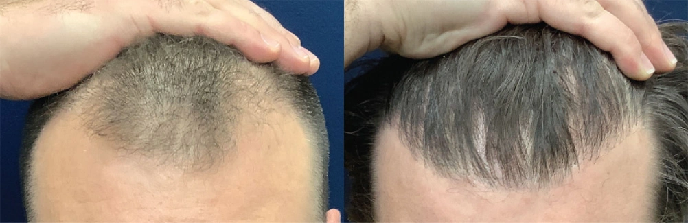 fue-2before.jpg