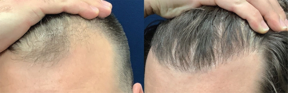 fue-3before.jpg