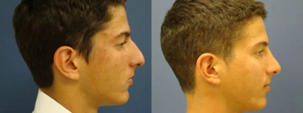 1595525011-rhinoplasty-2
