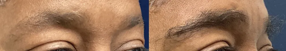 brows-case-2