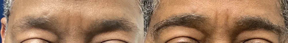 brows-case-2b