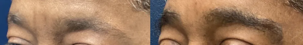 brows-case-2c