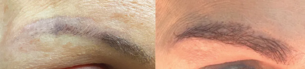 brows.case 1.b