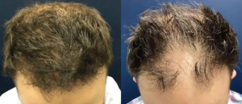 hair-restoration-p01-01