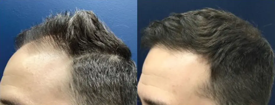hair-restoration-p01-02
