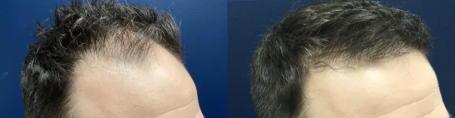 hair-restoration-p01-03