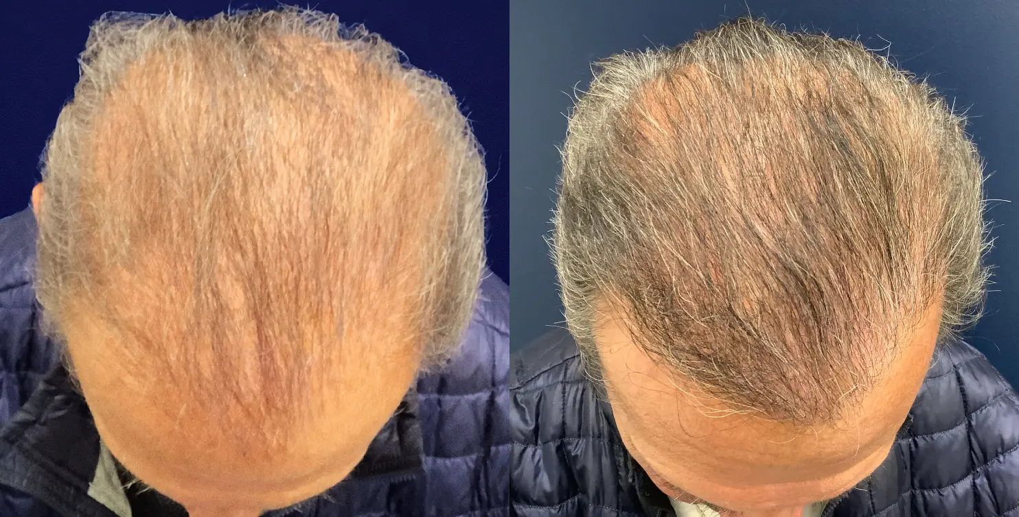 hair-restoration-p02-01