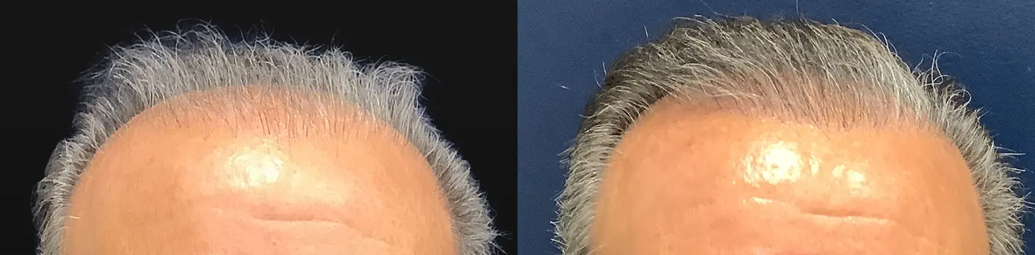 hair-restoration-p02-02