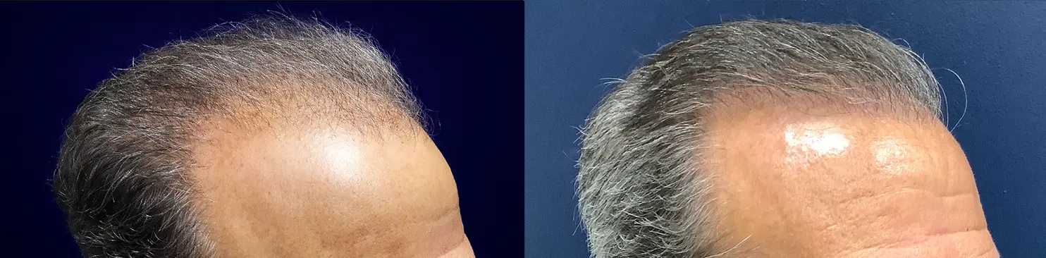 hair-restoration-p02-03