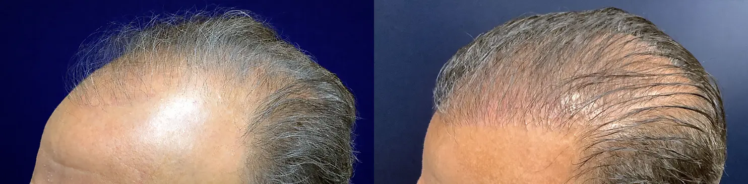 hair-restoration-p02-04