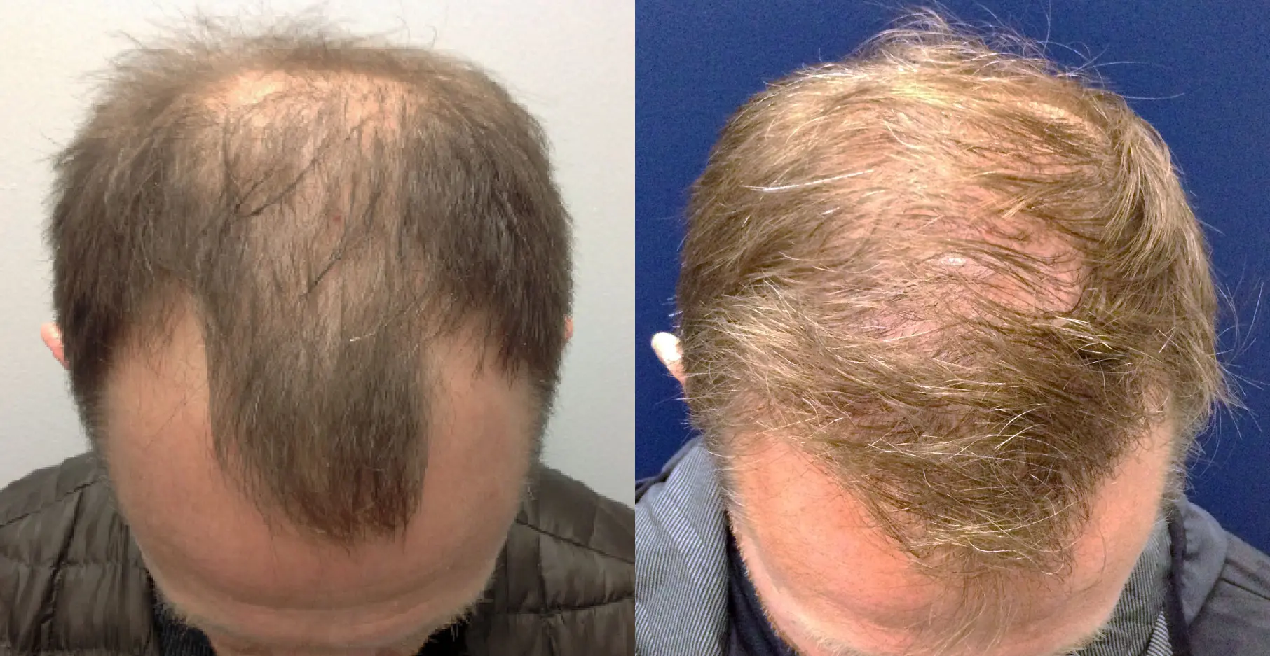 hair-restoration-p03-01