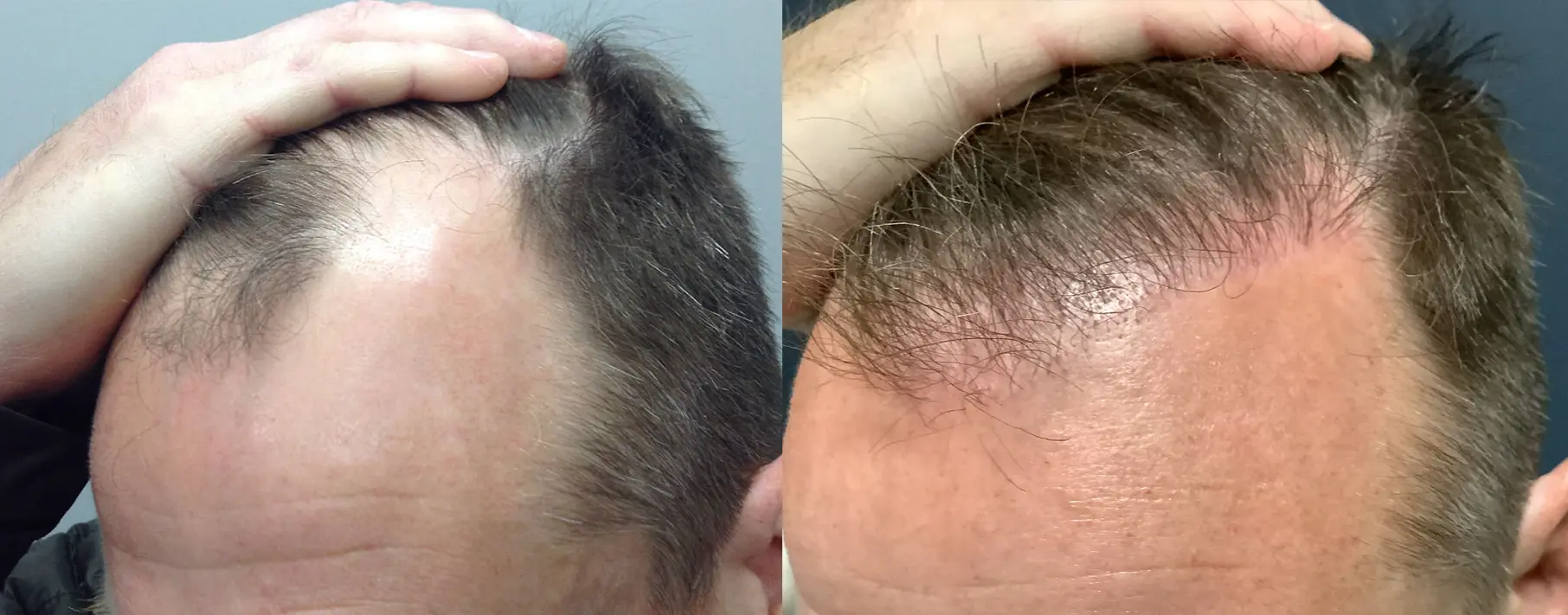 hair-restoration-p03-02
