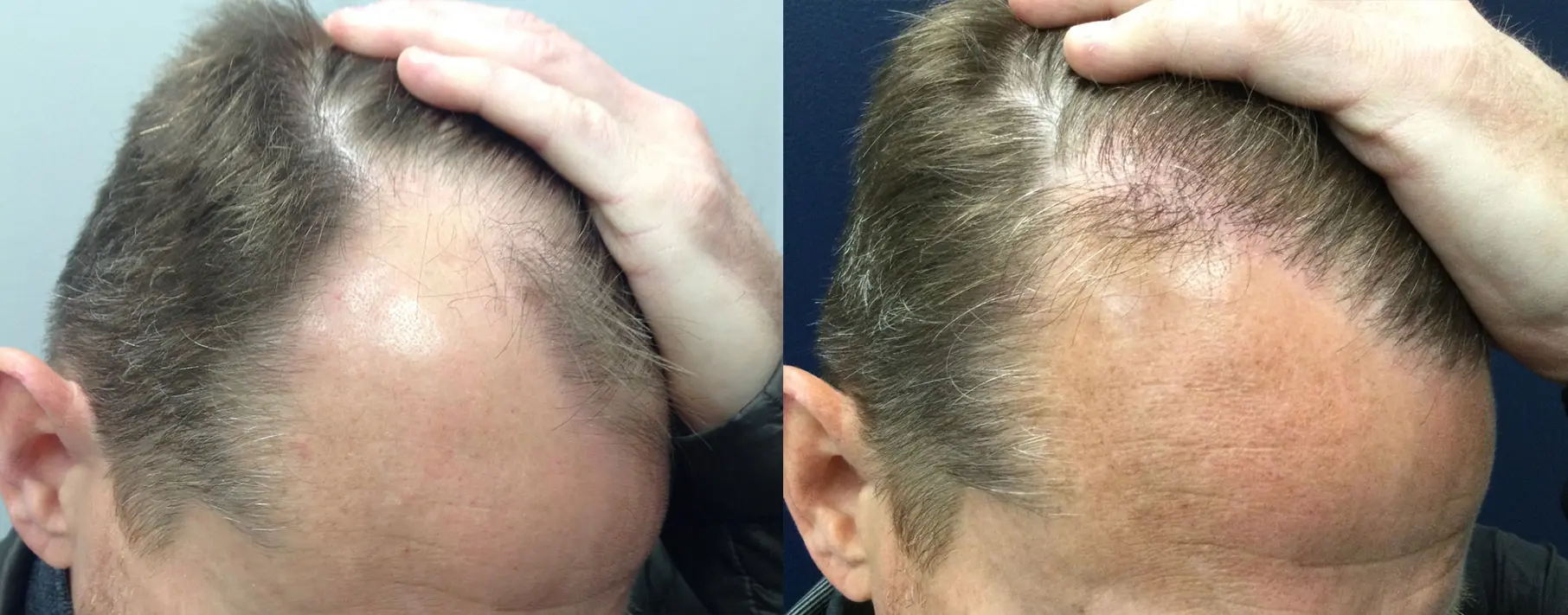 hair-restoration-p03-03