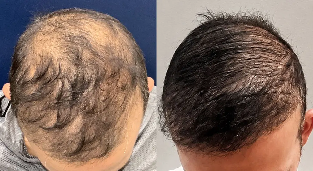 hair-restoration-p04-01
