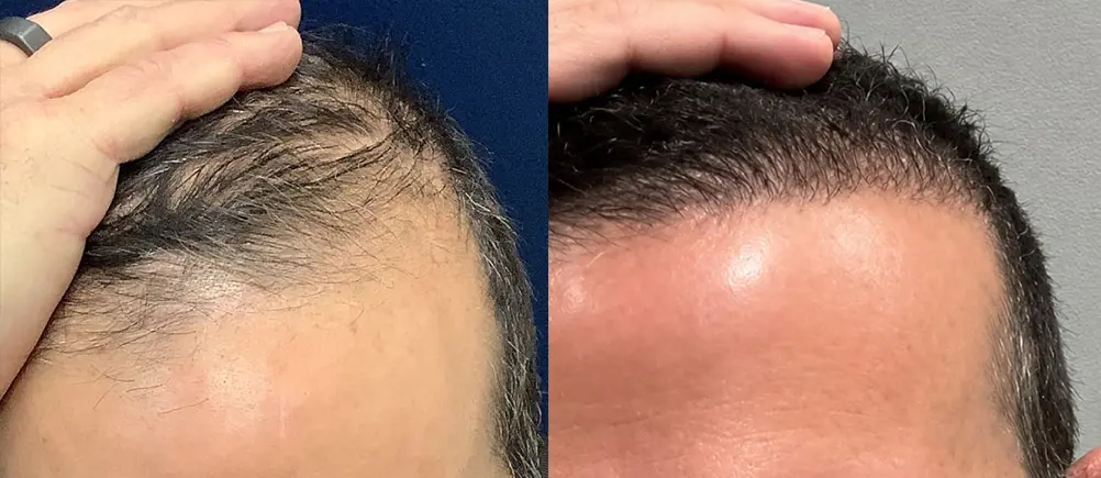 hair-restoration-p04-02
