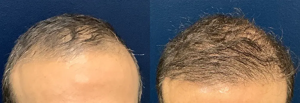 hair-restoration-p04-03