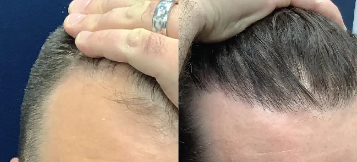 hair-restoration-p05-01