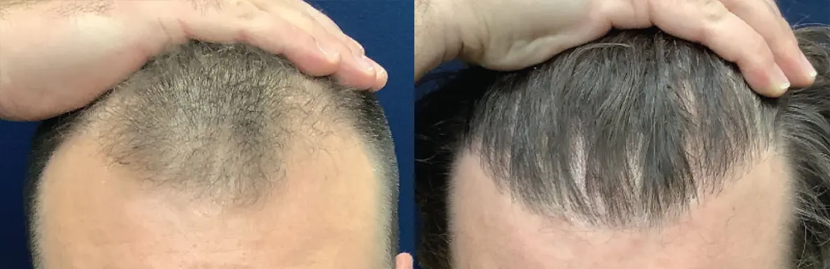 hair-restoration-p05-02