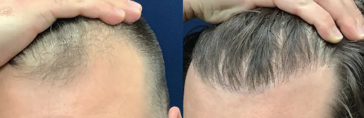 hair-restoration-p05-03