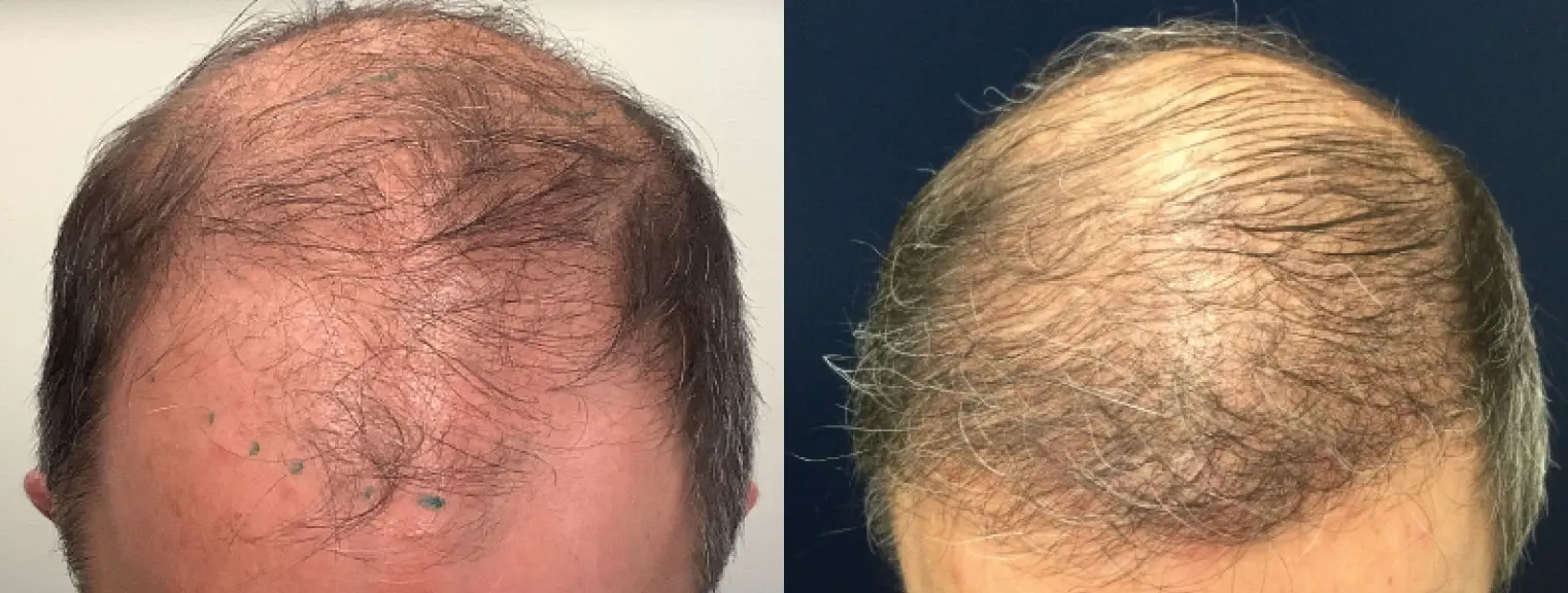 hair-restoration-p06-01