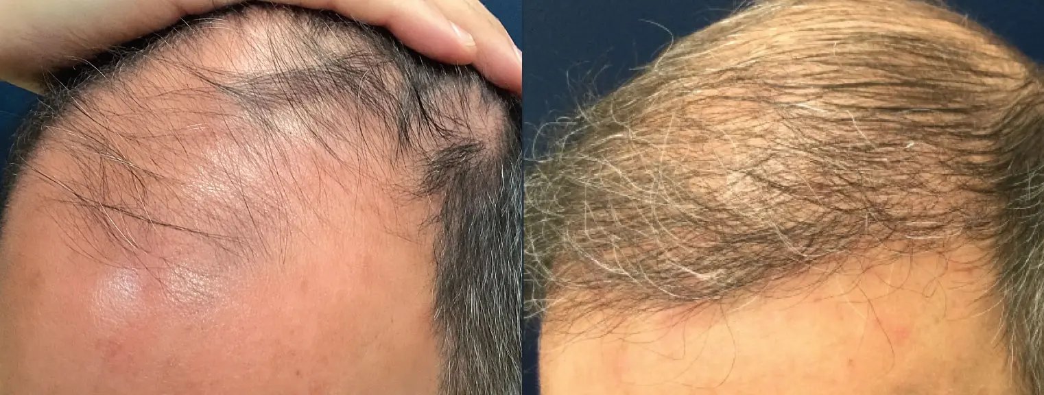 hair-restoration-p06-02
