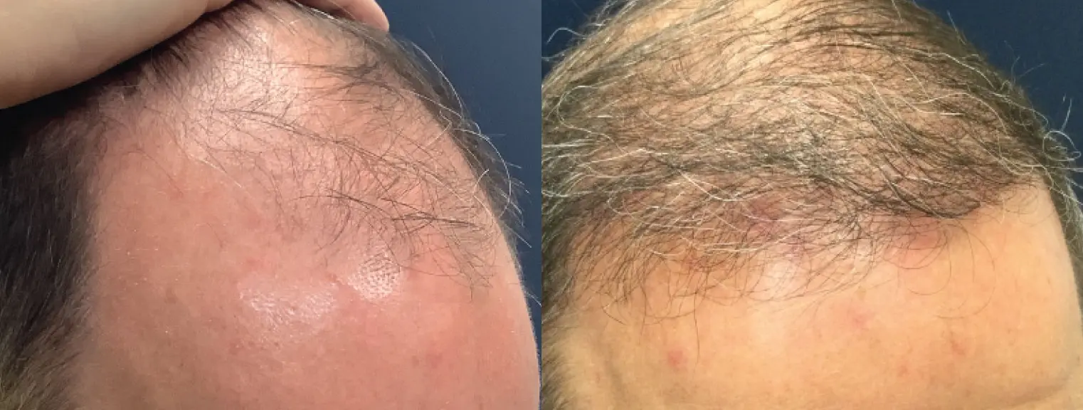 hair-restoration-p06-03