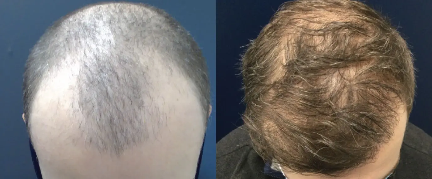hair-restoration-p07-01