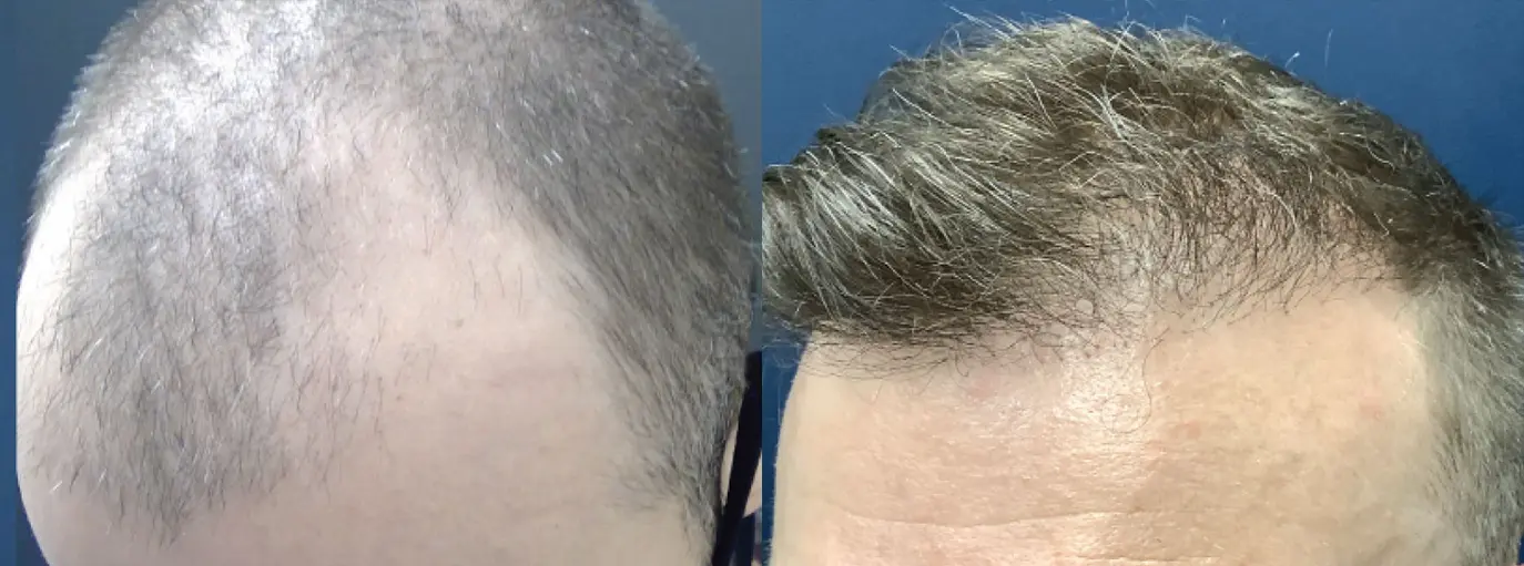 hair-restoration-p07-02