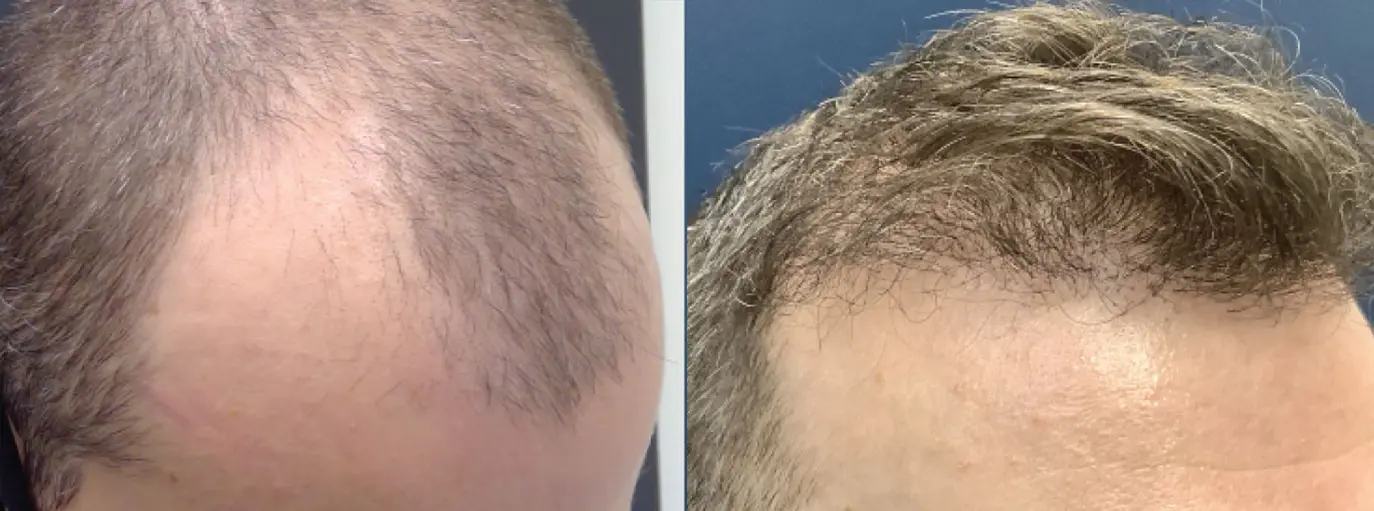 hair-restoration-p07-03