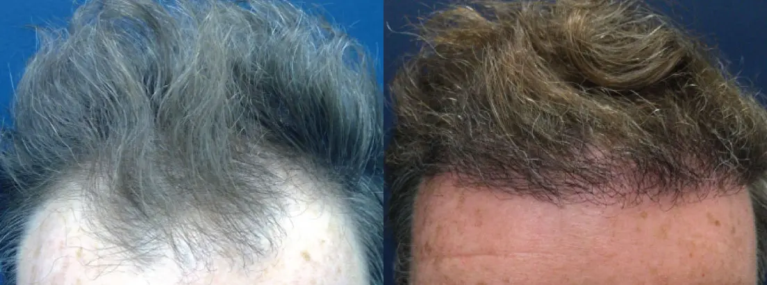 hair-restoration-p08-01