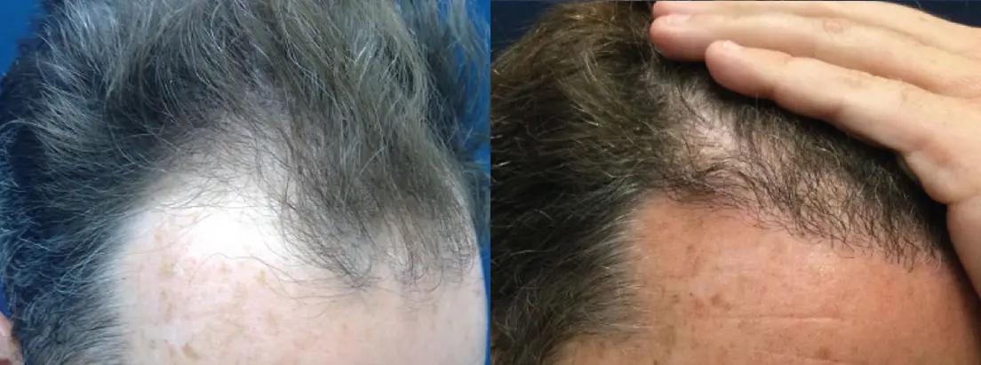 hair-restoration-p08-02