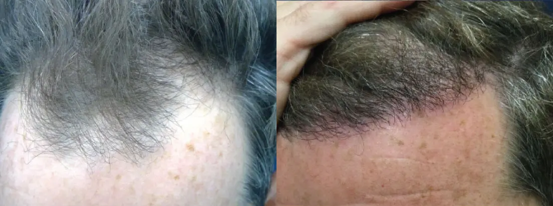hair-restoration-p08-03