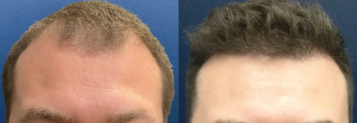 hair-restoration-p09-01