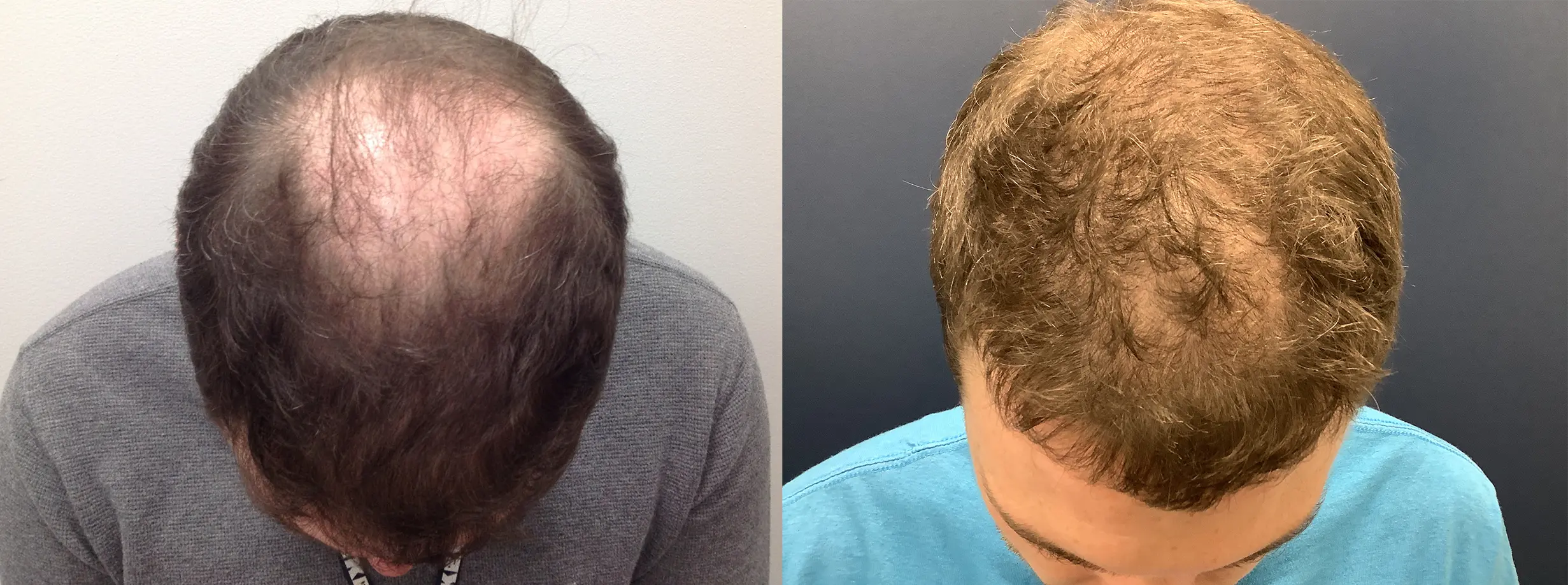 hair-restoration-p10-01