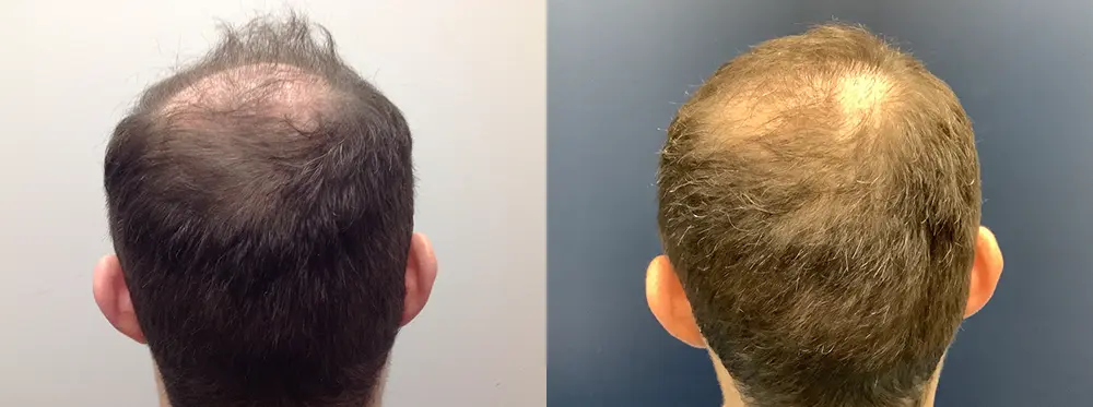 hair-restoration-p10-02